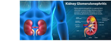 Böbrek glomeruloskleroz illüstrasyonunun tıbbi bilgileri
