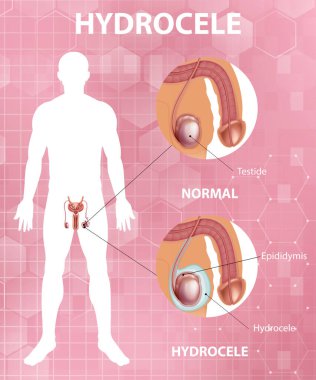 Medical poster showing different between male normal testicle and hydrocele illustration