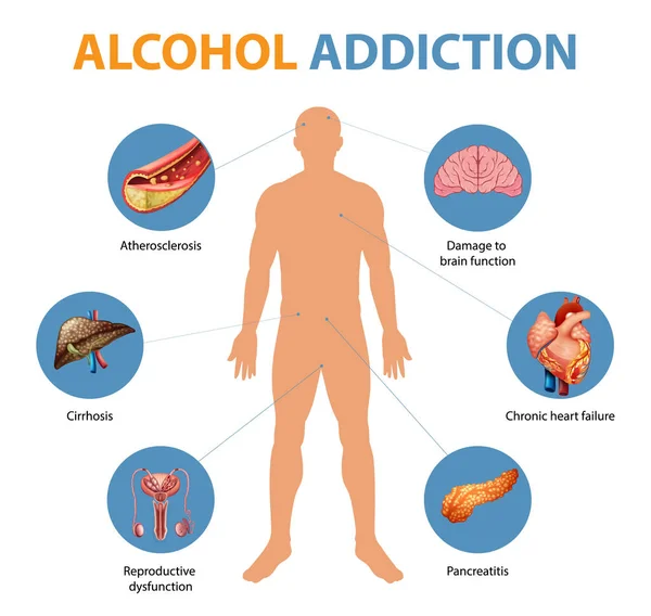 Addisons Sjukdom Symptom Infographic Illustration — Stock vektor