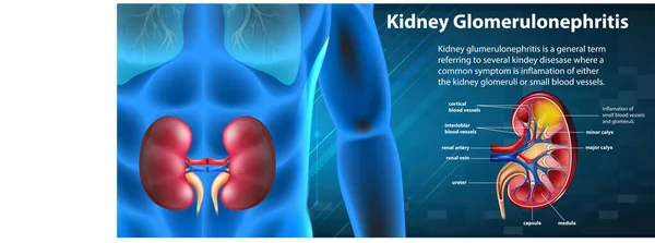 Medizinische Infografik Zur Illustration Von Nierenglomerulosklerose — Stockvektor