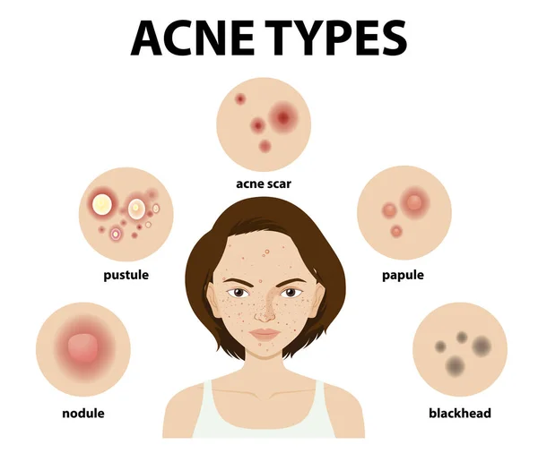 Soorten Acne Huid Puistjes Illustratie — Stockvector