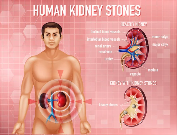 Ilustrasi Yang Informatif Dari Gambar Batu Ginjal - Stok Vektor