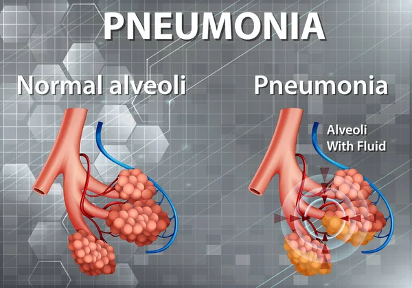 Anatomia Humana Mostrando Pneumonia Ilustração — Vetor de Stock