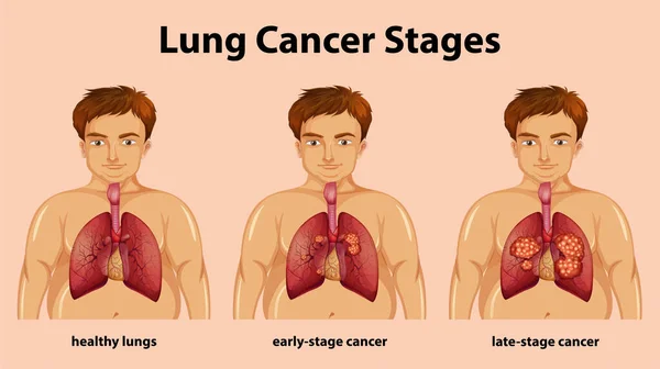 Ilustración Informativa Los Estadios Del Cáncer Pulmón — Archivo Imágenes Vectoriales