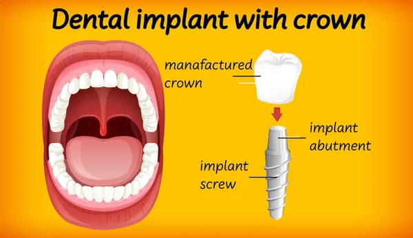 Zubní Implantát Korunní Ilustrací — Stockový vektor