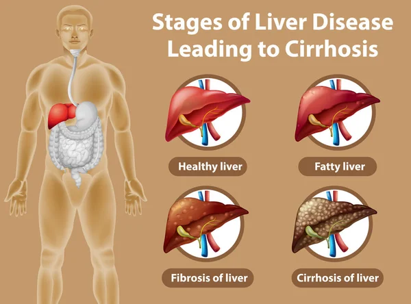 肝病导致肝硬化的各个阶段 — 图库矢量图片