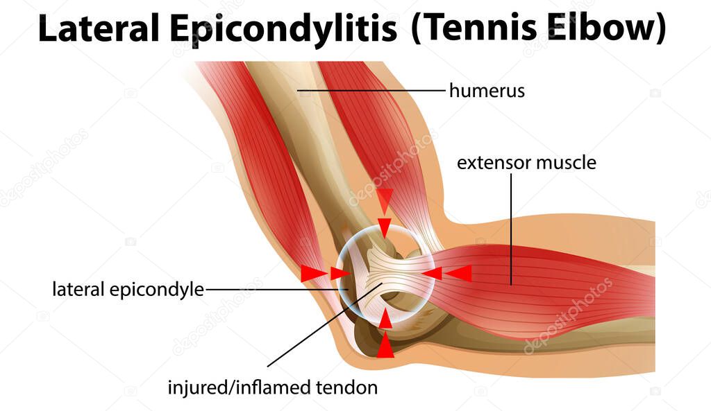 Lateral Epicondylitis or tennis elbow illustration