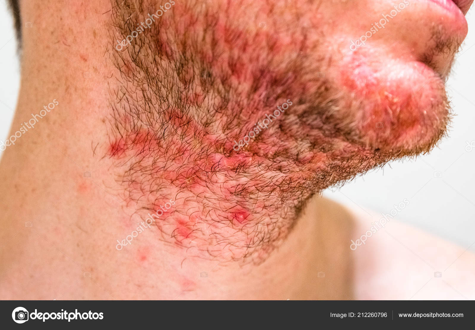 szakáll dermatitis
