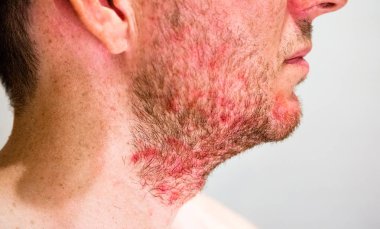 Sakal bölgesinde Seboreik dermatit olan adam