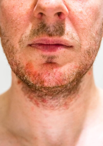 Man with seborrheic dermatitis in the beard area