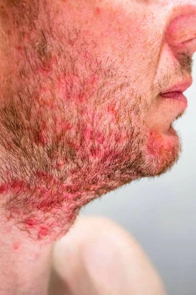 ひげ領域に脂漏性皮膚炎を持つ男 — ストック写真
