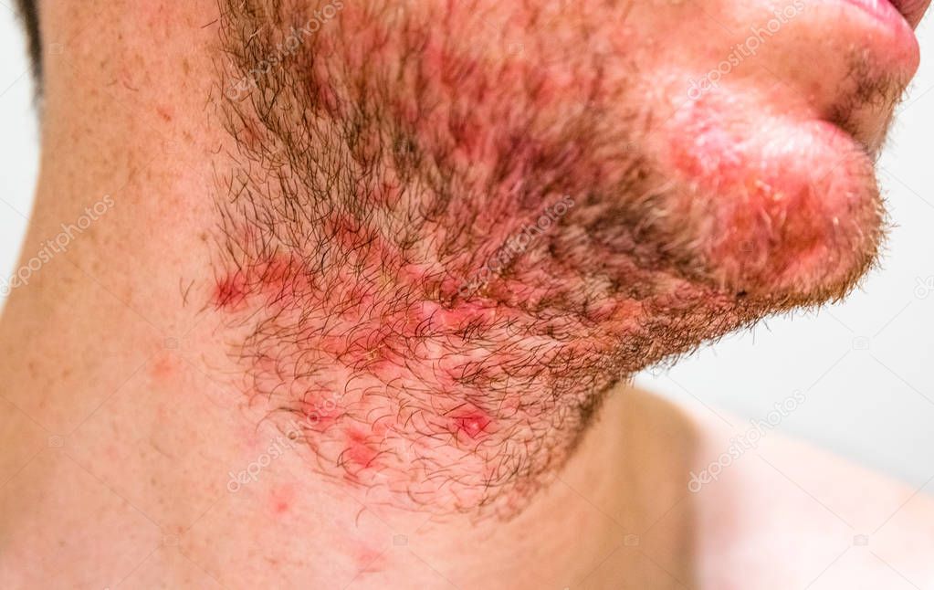 Man with seborrheic dermatitis in the beard area