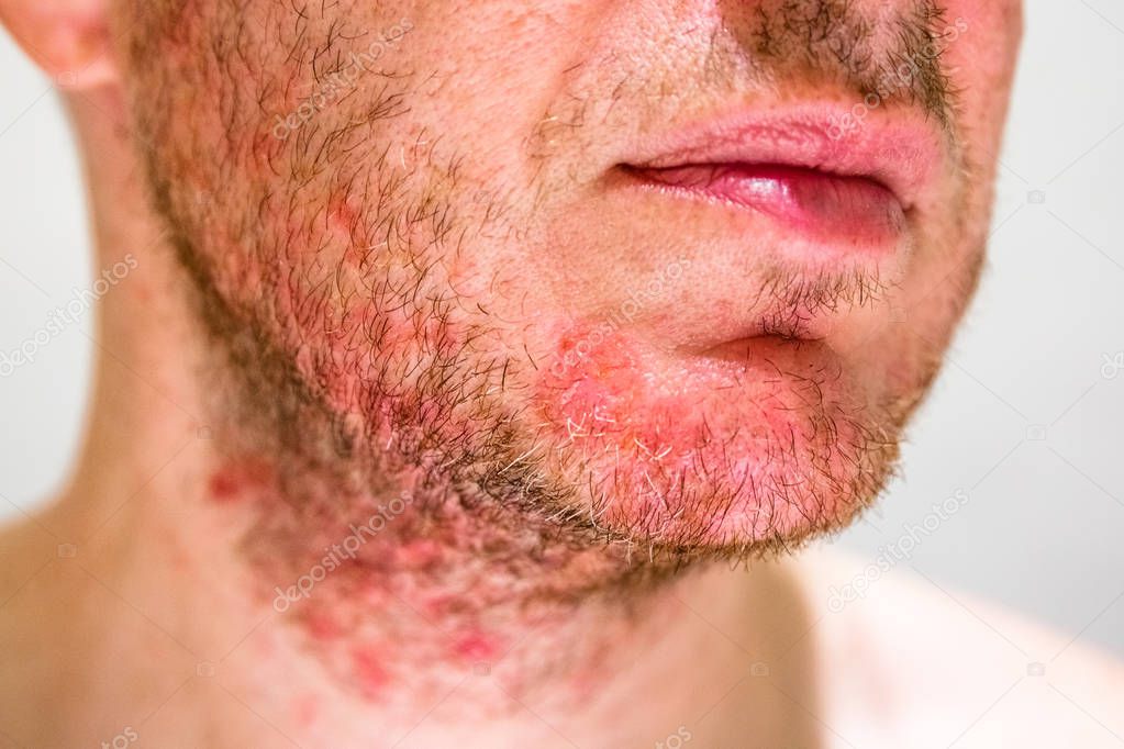 Man with seborrheic dermatitis in the beard area