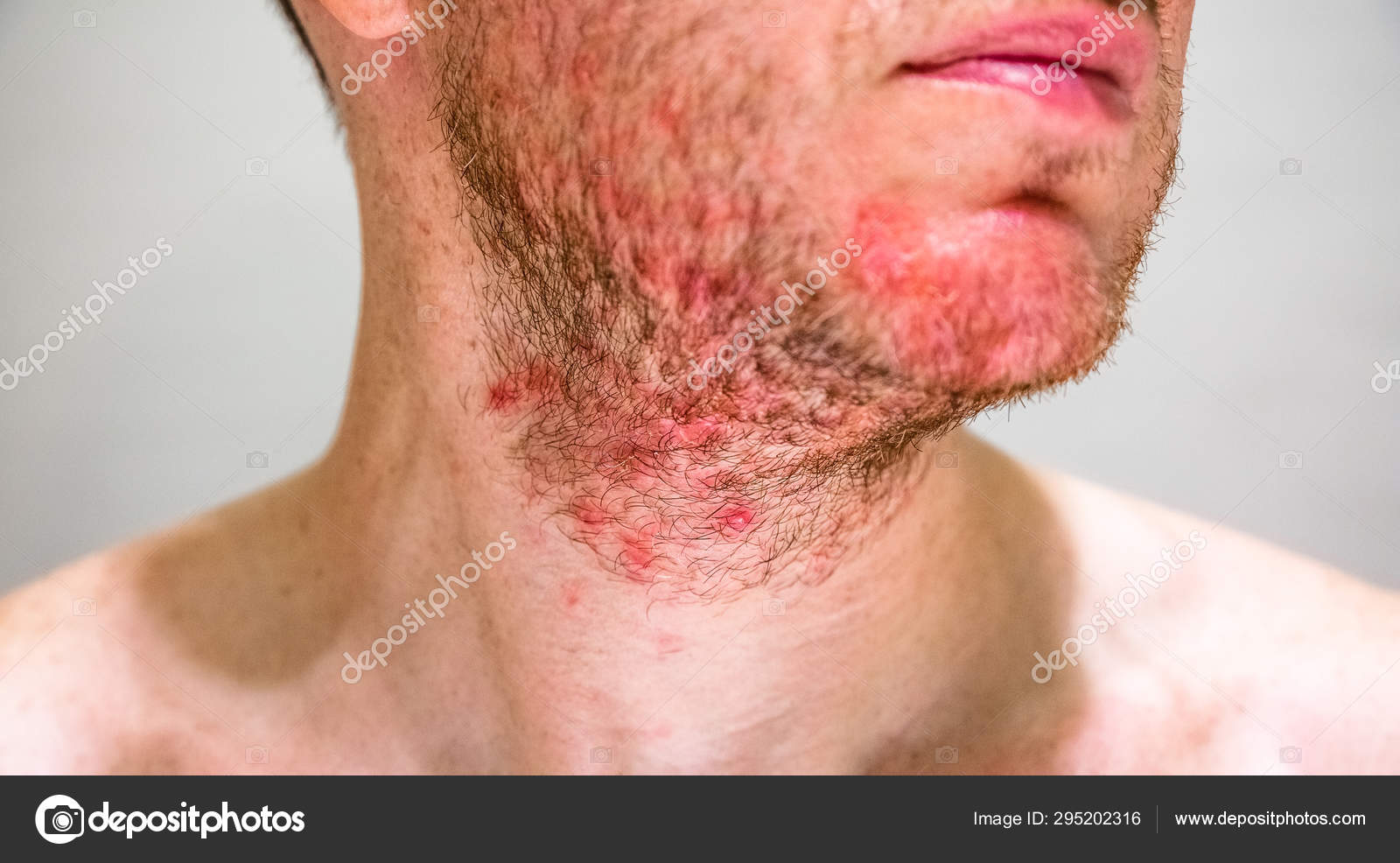 Dicas para Cuidar do Cavanhaque e Foliculite, image size:1600x986