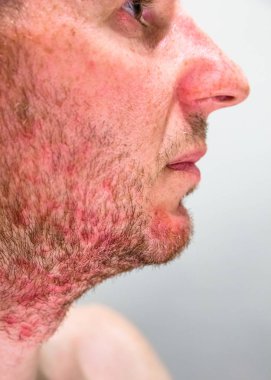 Sakal bölgesinde Seboreik dermatit olan adam