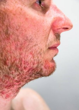 Man with seborrheic dermatitis in the beard area clipart