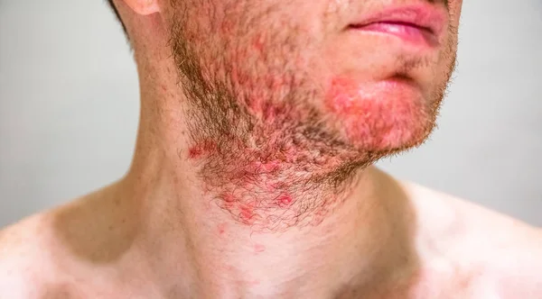 Homem com dermatite seborreica na zona da barba — Fotografia de Stock