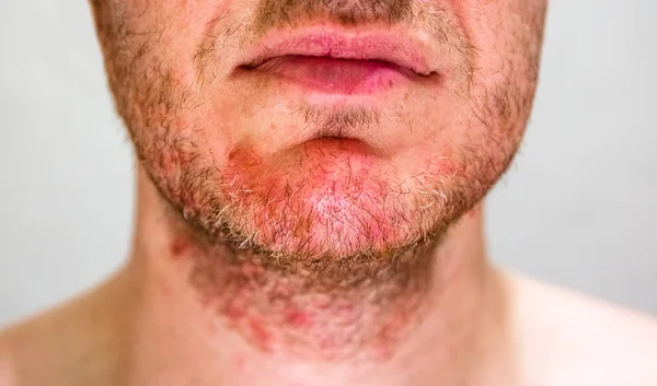 Человек с себорейным дерматитом в области бороды — стоковое фото
