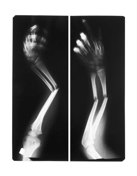 Mostrar fratura dupla ossos do braço — Fotografia de Stock