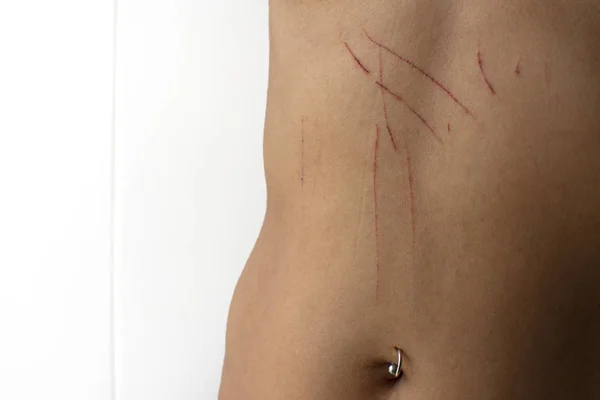 Sprucken Hud Repor Sår Huden Blod Repor Cat Vit Bakgrund — Stockfoto