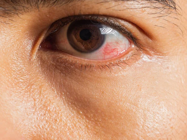 Closeup Irritated Red Blood Eyes Male Affected Conjunctivitis Flu Cold — Stock Photo, Image
