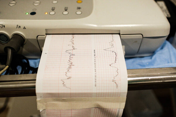 Электрокардиограмма медицинское устройство, показывающее диаграмму здоровья пациента
