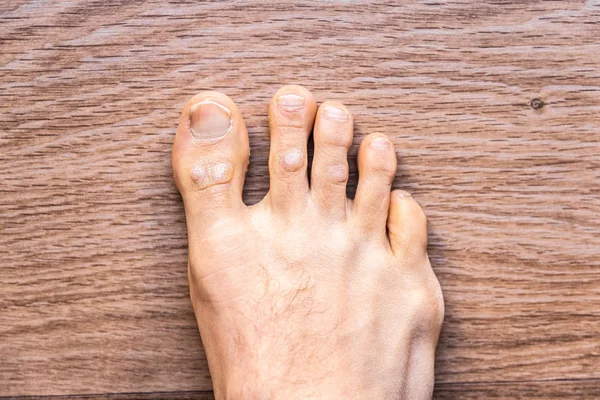Pés de homem descalço com dermatite da psoríase nos dedos . — Fotografia de Stock