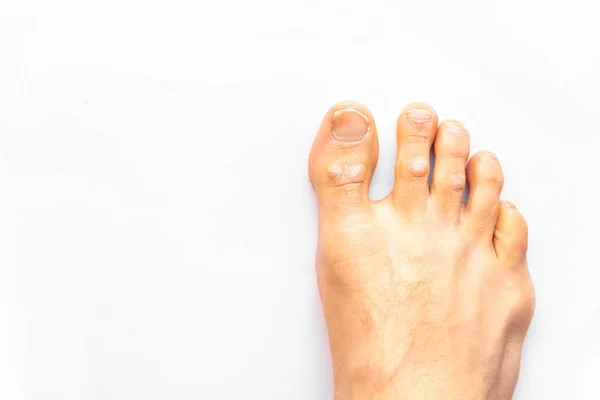 Right foot affected with psoriasis, on a patient in the podiatri