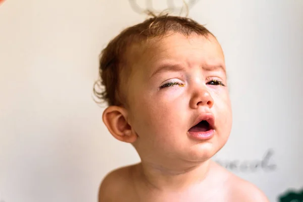 A baby with eyes full of rheum, produced by conjunctivitis, infl — Stock Photo, Image