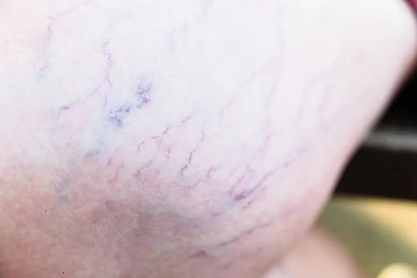Oturan bir kadının bacağında varisli damarların Detayı. — Stok fotoğraf