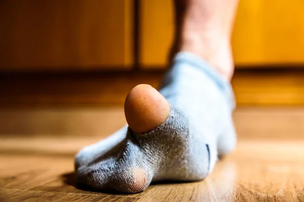 Meia partida com um buraco no dedo grande de um homem, conceito de pobreza d — Fotografia de Stock