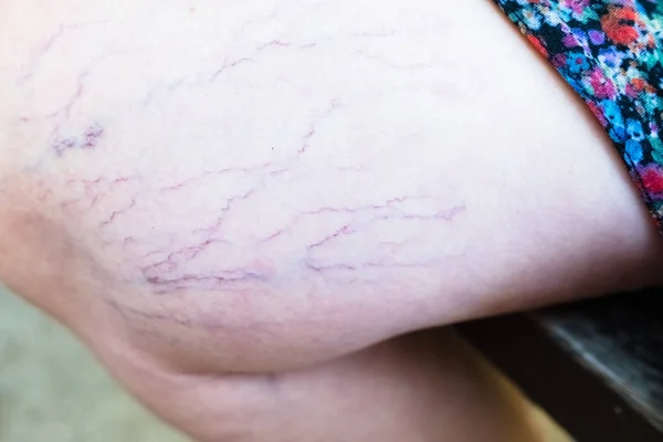 Detalhe de varizes na perna de uma mulher sentada . — Fotografia de Stock