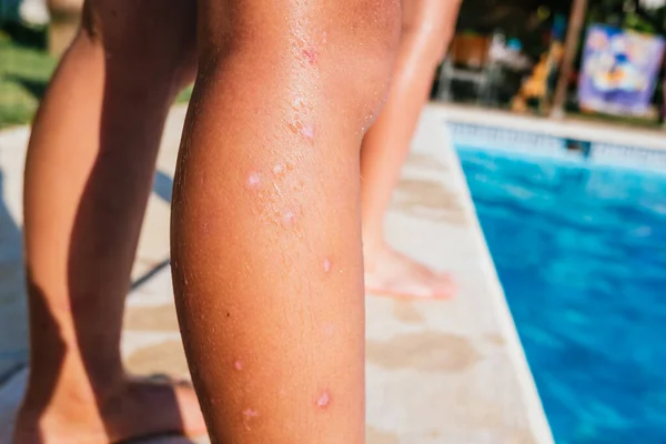 Pierna Infantil Con Picaduras Mosquitos Heridas Una Piscina Verano —  Fotos de Stock