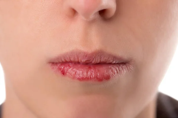 Closeup womans face with brittle and dry lips concept lip salve and wounds