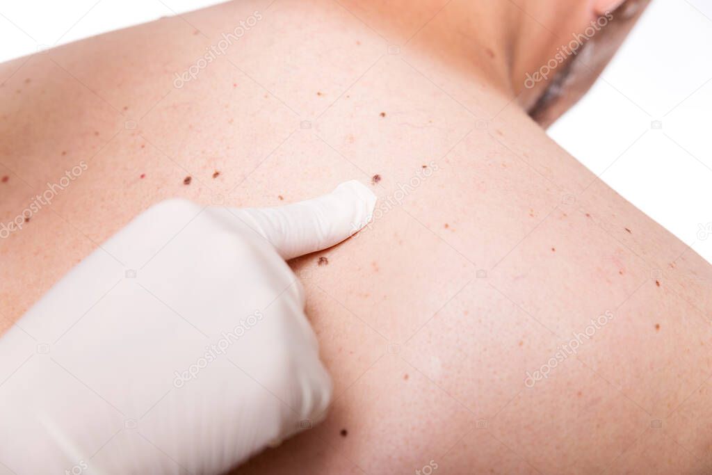 screening the skin of a man with moles