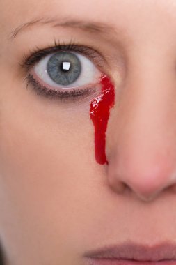 Yaklaş, genç bayan. Kanlı gözyaşları, damar hastalıkları, kanama.
