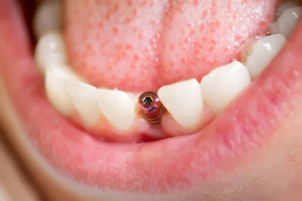 Herramientas de dentista. Hermosa sonrisa de mujer joven con primer plano del implante dental para el diseño de la atención médica . — Foto de Stock