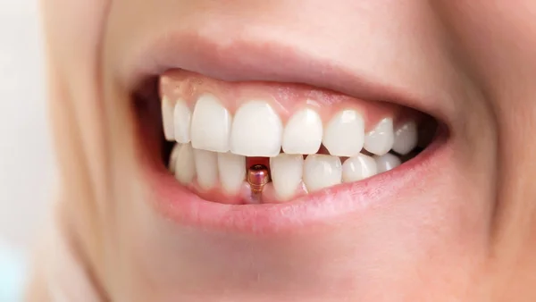 Strumenti per dentisti. Bella giovane donna sorriso con primo piano di impianto dentale per la progettazione sanitaria . — Foto Stock