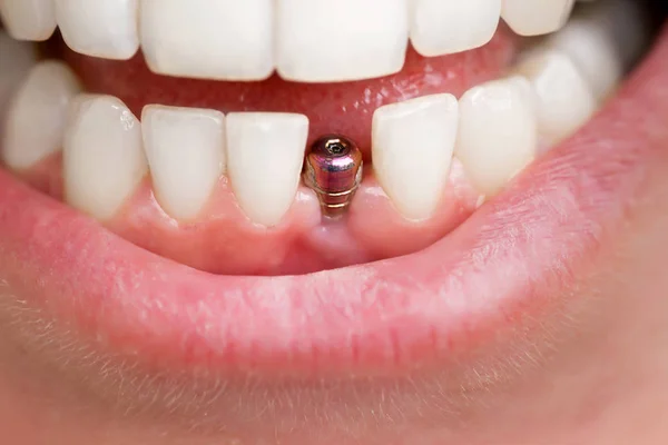 Zubní nástroje. Krásná mladá žena se usmívá s těsnčnickým implantátem na zdravotní design. Stock Snímky