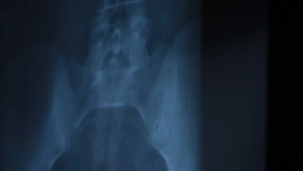 Radiographie Thorax Pack Secousses Brouille — Video