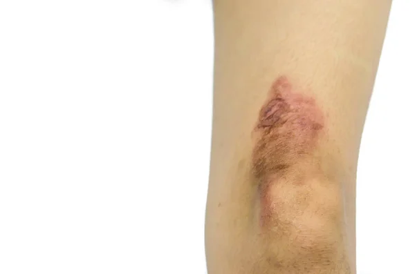 Scald leg — Stock Photo, Image