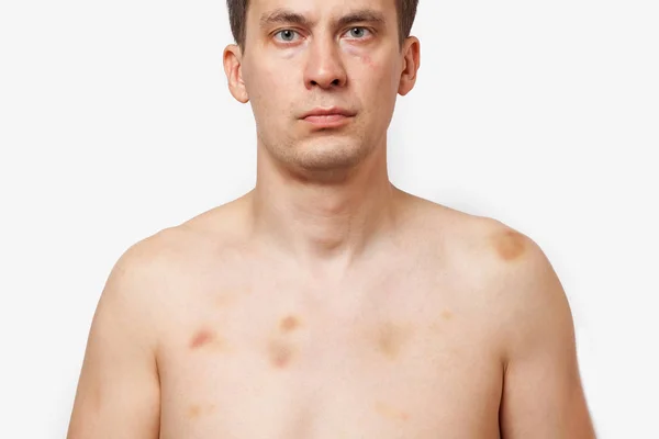 布鲁内特男子与伤痕在他的身体站在赤裸裸的躯干 — 图库照片