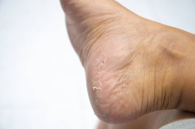 Topuk dermatit sonu, cilt yürüyerek erkeklerde soyma kapatın.