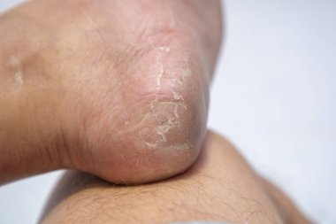 Topuk dermatit sonu, cilt yürüyerek erkeklerde soyma kapatın.