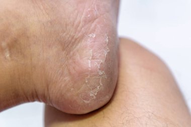 Topuk dermatit sonu, cilt yürüyerek erkeklerde soyma kapatın.
