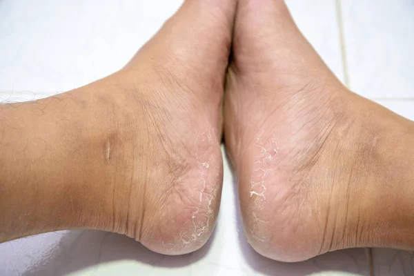 闭合性脚跟断裂皮炎 足部男性皮肤脱皮 — 图库照片