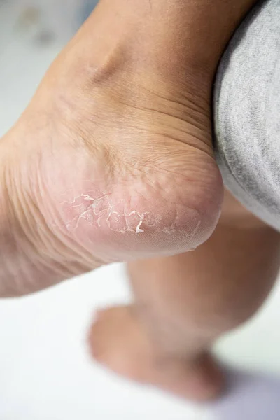 Close up Dermatitis of Heel break, Skin peeling in men on foot.