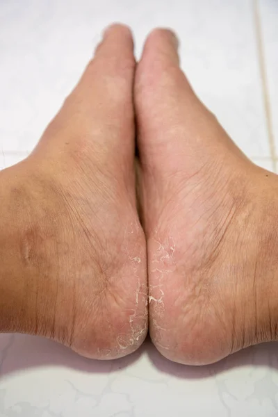 Close Dermatitis Heel Break Skin Peeling Men Foot — Stock Photo, Image