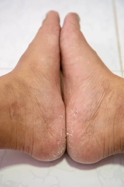 Topuk dermatit sonu, cilt yürüyerek erkeklerde soyma kapatın.