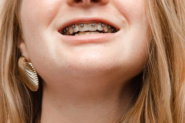 Extreme close-up adolescente donna sorridente con la bocca aperta che mostra bretelle sui denti — Foto Stock